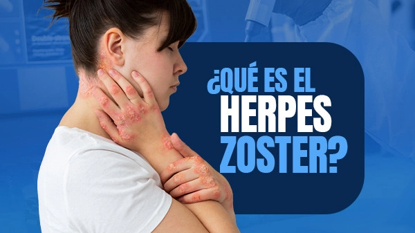 ¿Qué es el Herpes Zoster?